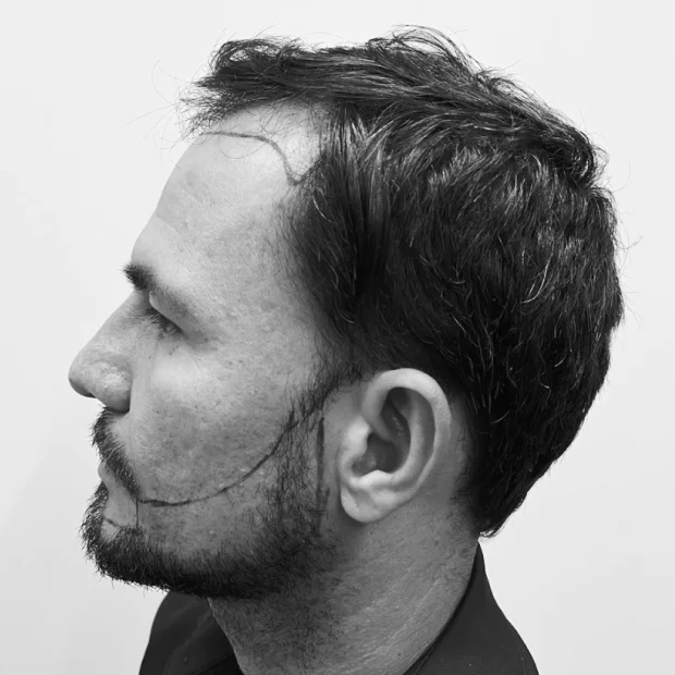 Transplante Capilar de Barba - Antes